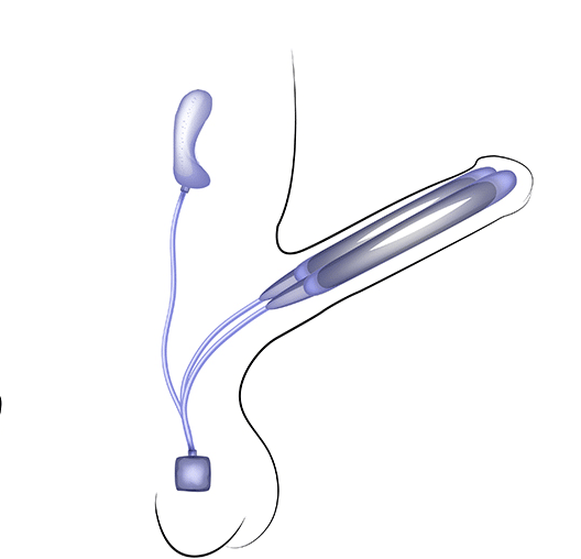 Three Piece Inflatable Penile Implant