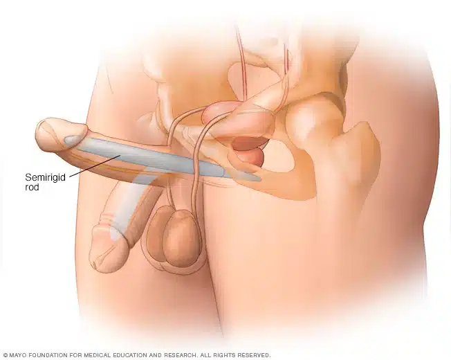 دعامة القضيب